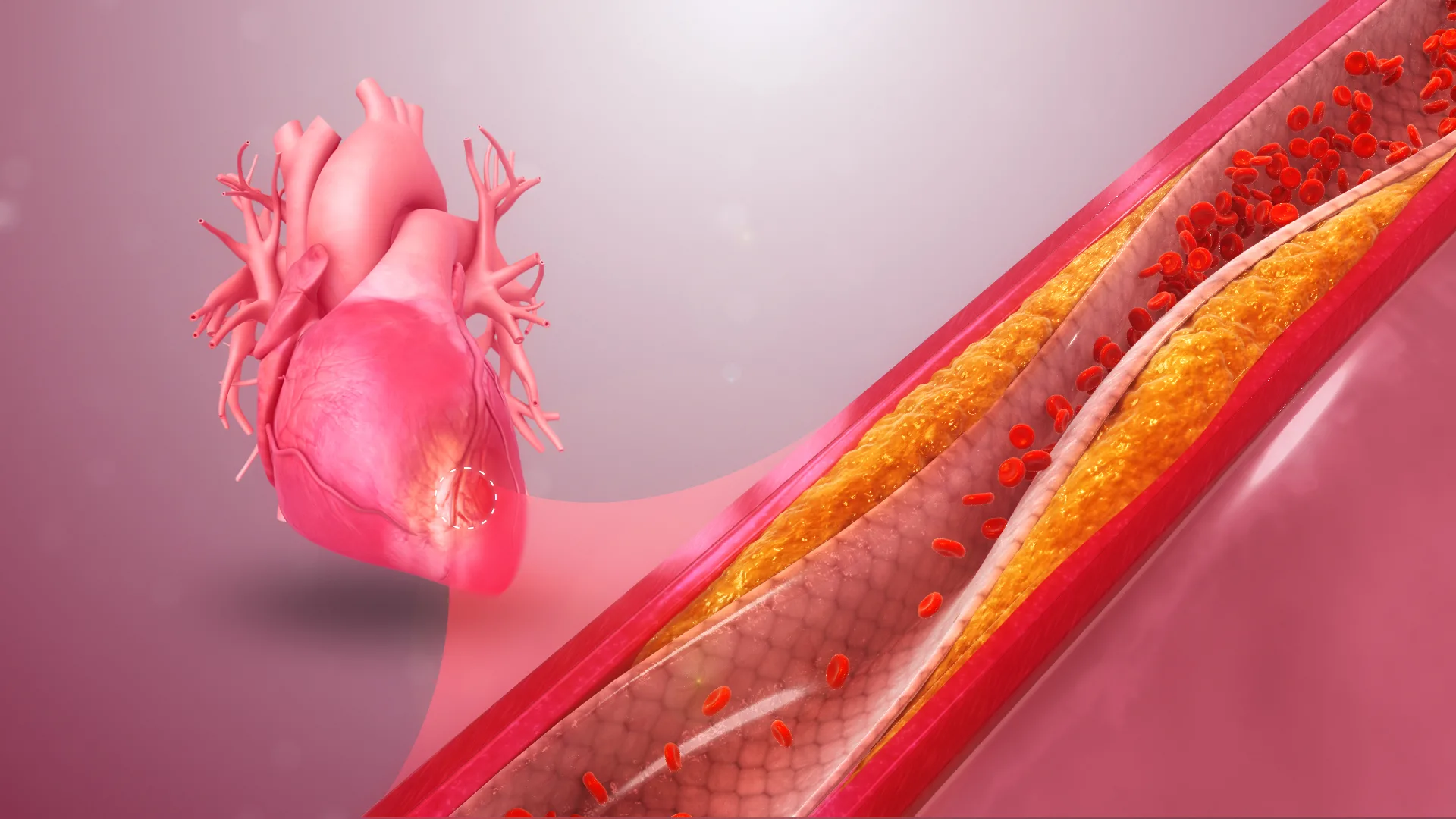 Introduction to FastWave Medical: An Emerging Intravascular Lithotripsy (IVL) Startup in the Lucrative $8.5 Billion Cardiovascular Market